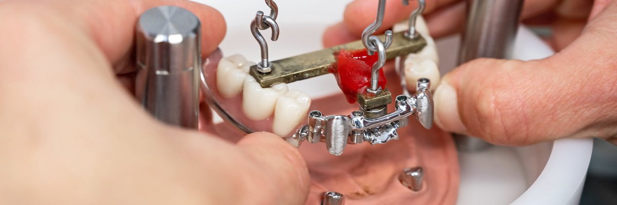 Zahnprothese am Modell