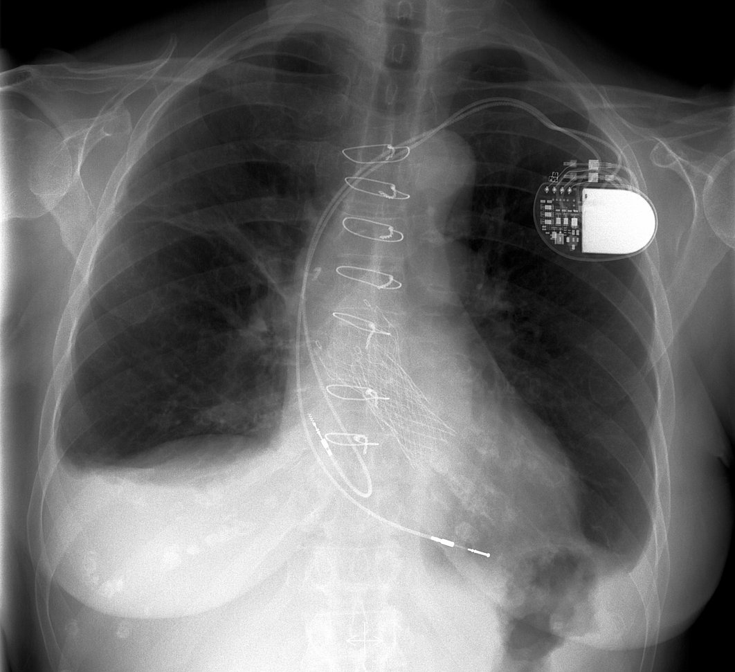 Röntgenbild eines Oberkörpers. Sichtbar ist ein Schrittmacher