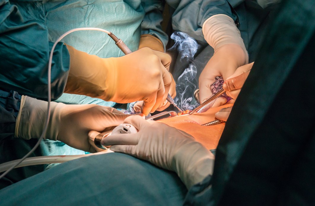 Operierende während einer Operation, Operationsinstrumente